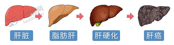 【健康】全球近一半肝癌在中国,提醒:家中的这4种食物,尽早撤下餐桌(组图) - 4