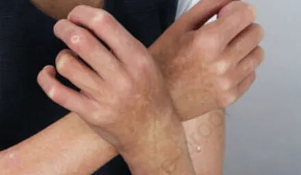 天一冷,手指就冰凉还变色…当心是这种病的早期信号(组图) - 3