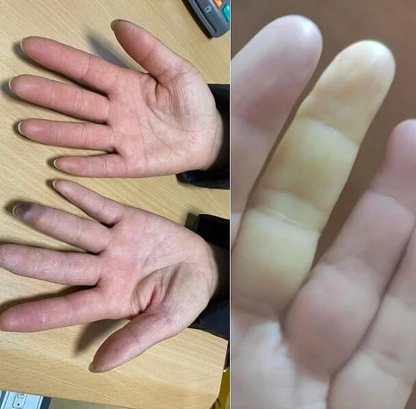 天一冷,手指就冰凉还变色…当心是这种病的早期信号(组图) - 1
