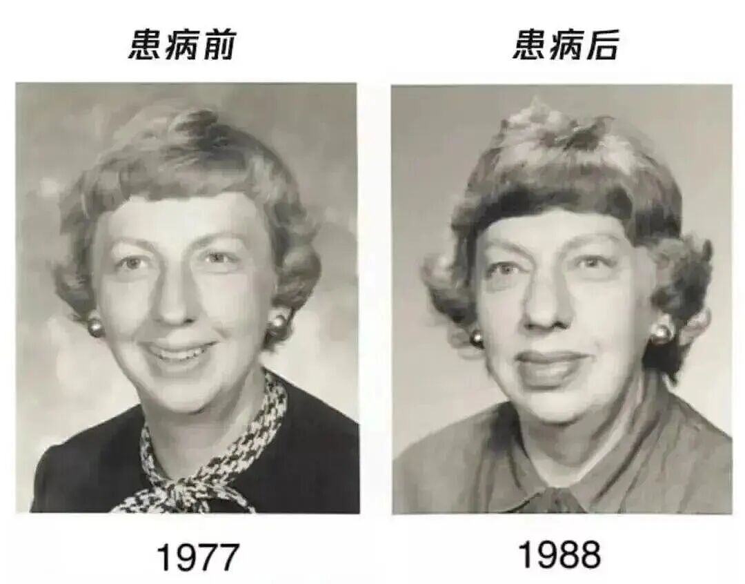面部出现此种变化可能是恶疾前兆,24岁清秀女子样貌突变,“不爱喝奶茶也没遗传史“(组图) - 3