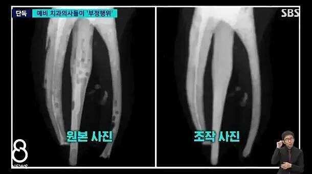 韩国顶尖大学医学生作弊，用PS修X光？牙齿根管做坏了直接P成好的，网友炸了...（组图） - 3