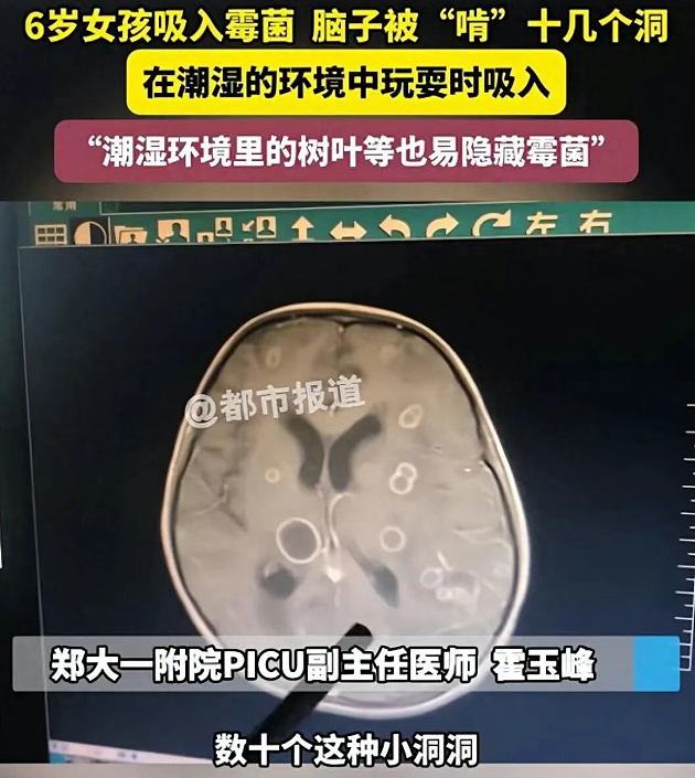 6岁女孩发烧17天，脑子被“啃”出十几个洞，差点被“啃空”！医生：“真凶”很常见（组图） - 1