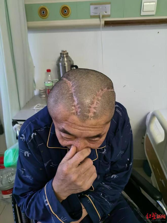 男子三年前右脑出血被开左脑,医生发现出错又开右脑(组图) - 1