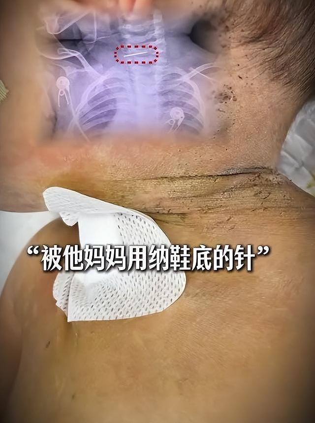 10月大男婴全身被母亲扎数百针放血，不听话就会被扎针，警方已介入（组图） - 1
