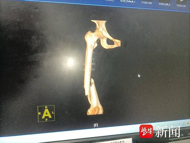 南京帅小伙给爬山摔断腿女士当“人肉靠垫”数小时等救援，医生赞处置非常专业（组图） - 2