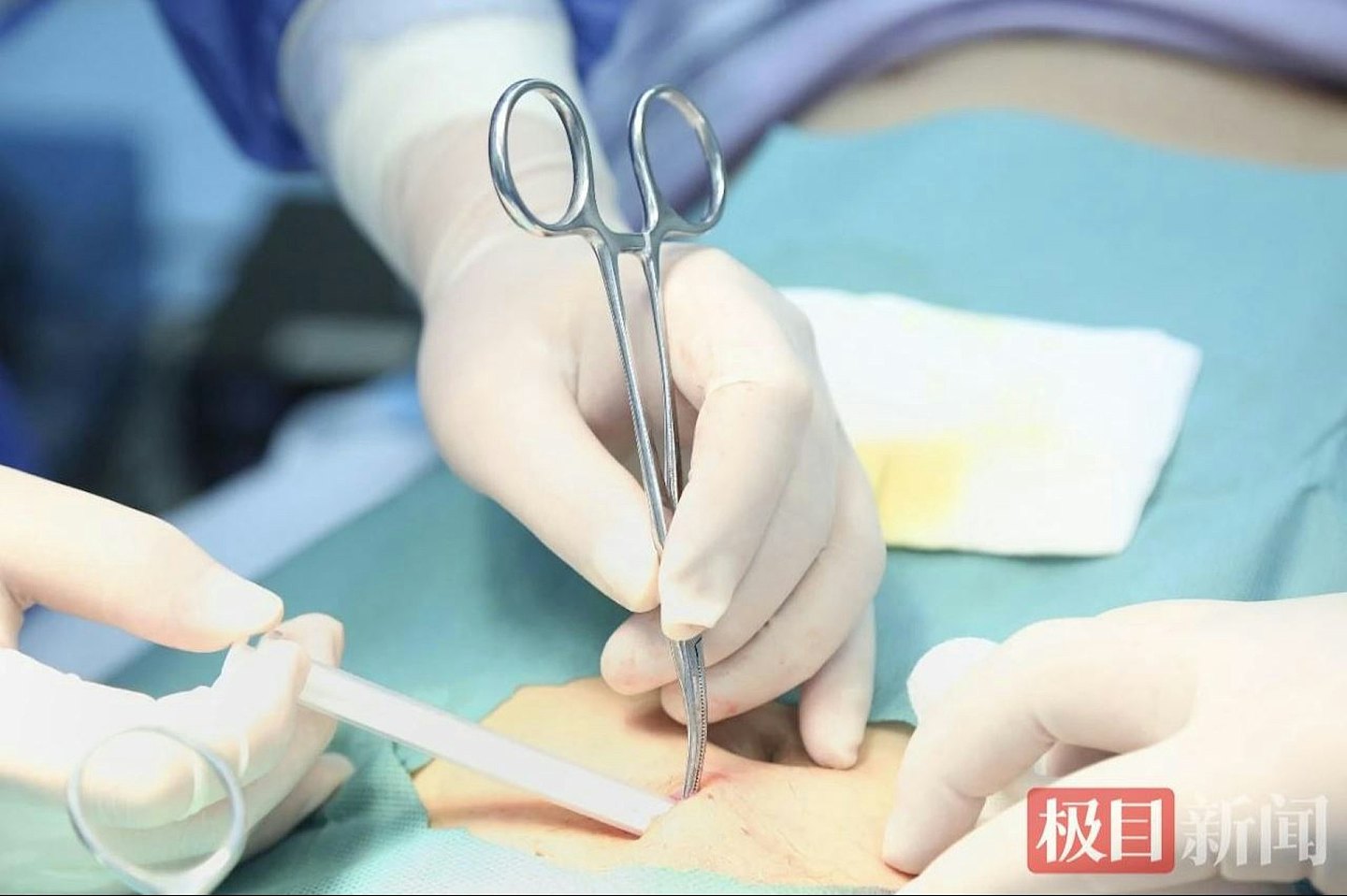 饮酒不再快乐!武汉医院实施“戒酒芯片“手术防复饮(组图) - 3