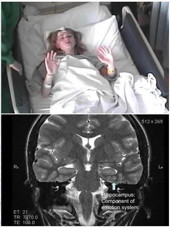这种毁灭性的脑病，总是袭击年轻人，而最难的是诊断出来（组图） - 2