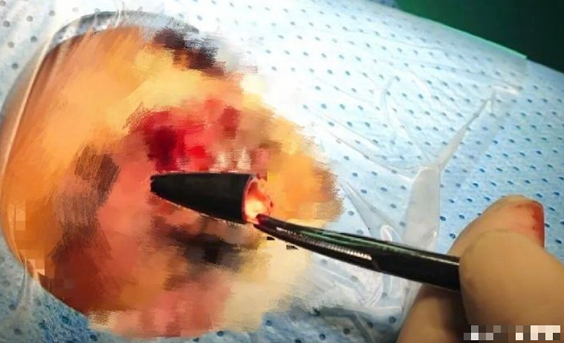 眼痛就医取出2.5cm原子笔头!深圳男:27年前被同学戳眼(组图) - 4