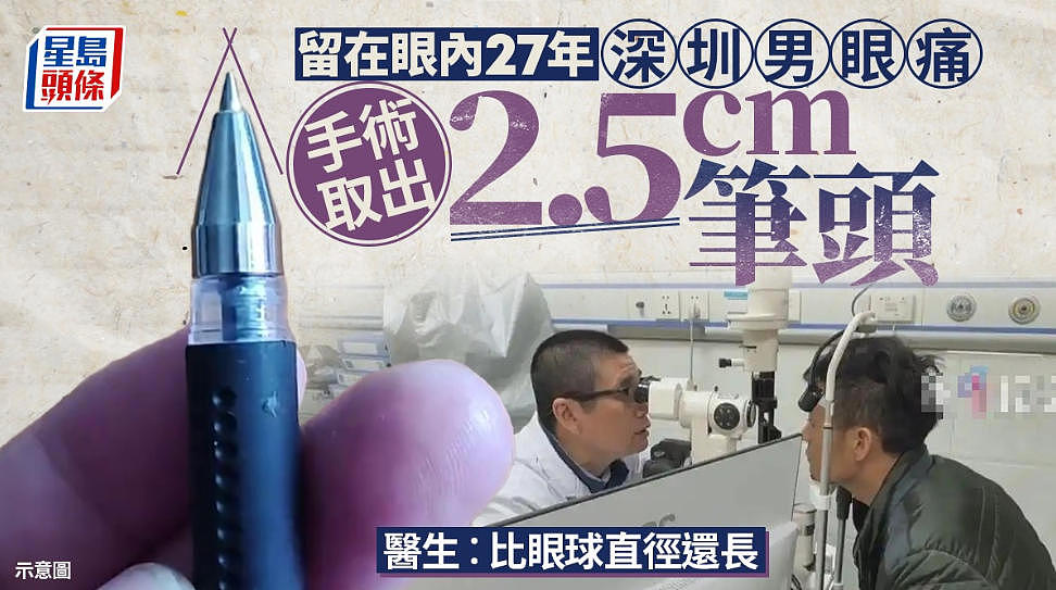 眼痛就医取出2.5cm原子笔头!深圳男:27年前被同学戳眼(组图) - 1
