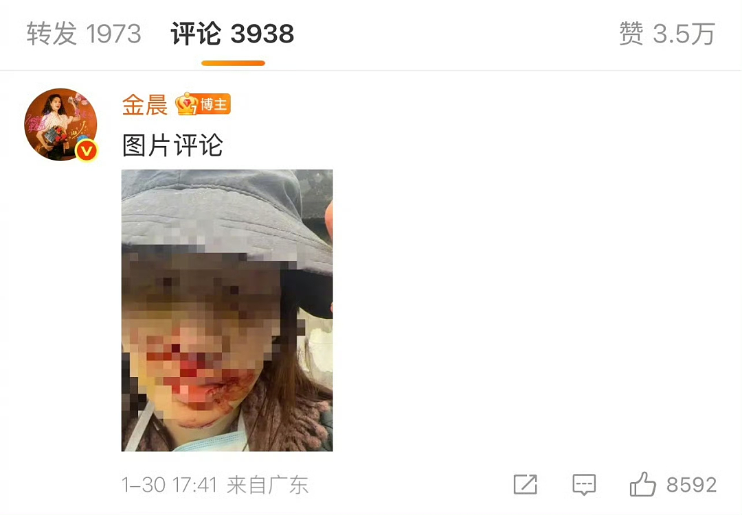 反转！金晨道歉！晒车祸受伤照，发文回应“肇事逃逸顶包”事件！警方通报：金晨助理谎称自己是驾驶员，不存在骗保（组图） - 4