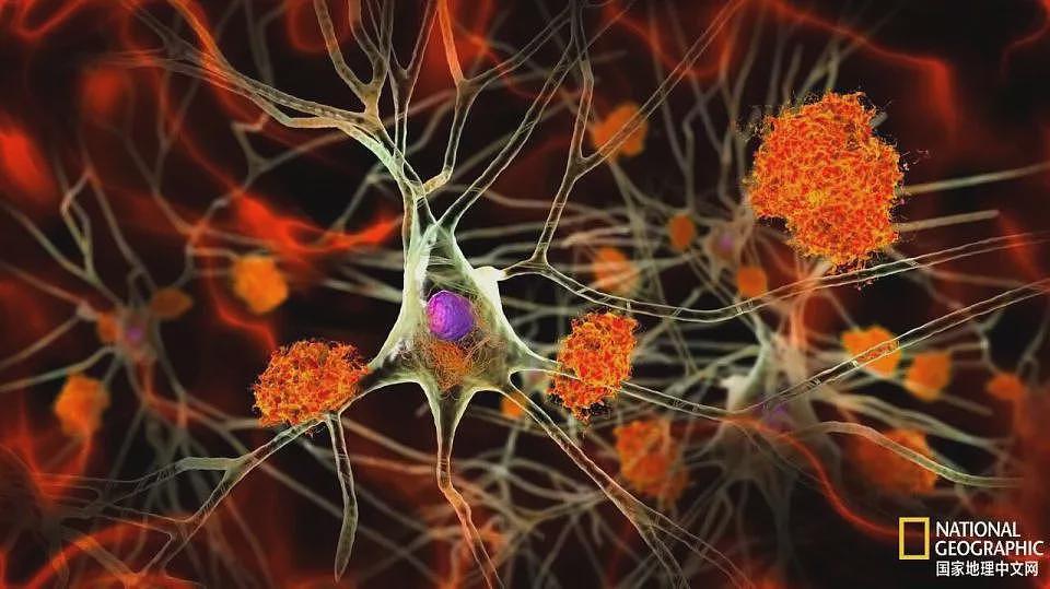 为何阿尔茨海默病人很少得癌症？科学家惊人发现（组图） - 4