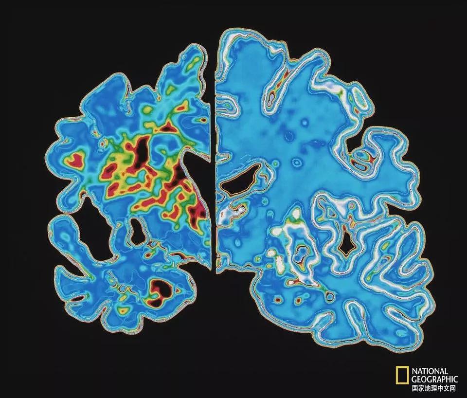 为何阿尔茨海默病人很少得癌症？科学家惊人发现（组图） - 3