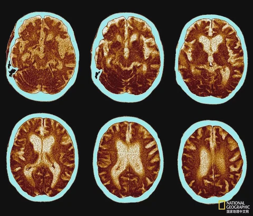 为何阿尔茨海默病人很少得癌症？科学家惊人发现（组图） - 1