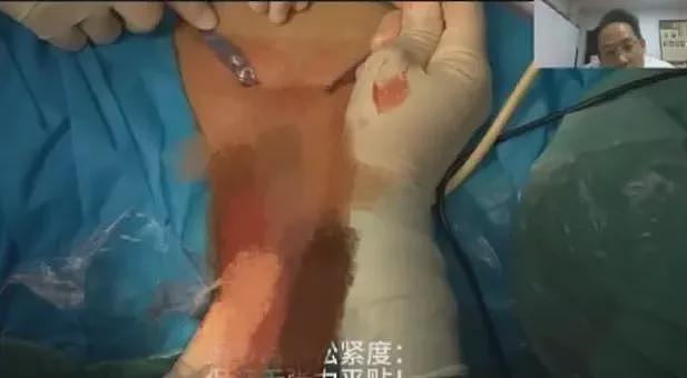 陕西医院手术直播 突现女患者私处 5万人涌入抢看(图) - 1