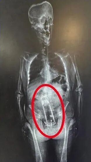 法国小哥往菊花塞炮弹后紧急求医，医生们倒吸一口凉气，叫来了警察围观...（组图） - 13