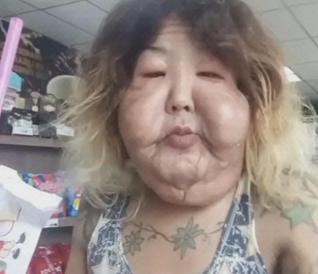 百万网红整容被注射21支矿物油+泻药!整张脸被毁,烂到变形!美国22名女子送医(组图) - 4