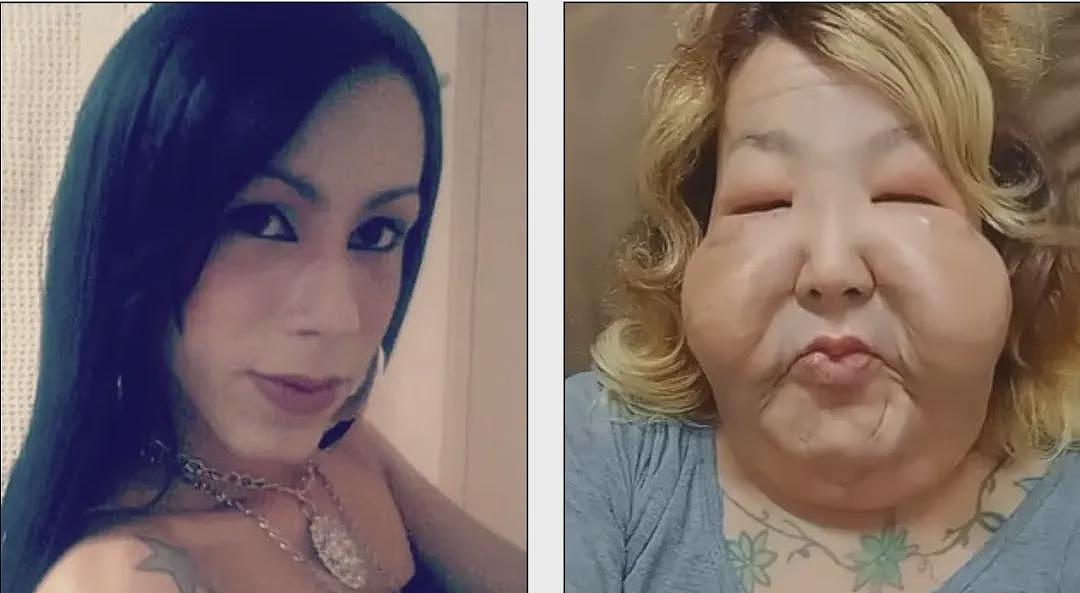 百万网红整容被注射21支矿物油+泻药!整张脸被毁,烂到变形!美国22名女子送医(组图) - 1