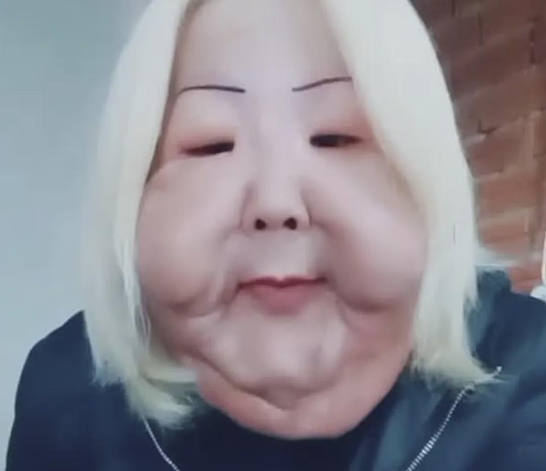 百万网红整容被注射21支矿物油+泻药!整张脸被毁,烂到变形!美国22名女子送医(组图) - 2