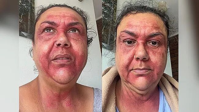 澳洲过敏性疾病比例飙升至30%！女子因极端天气面部“毁容”，门都不敢出（组图） - 2