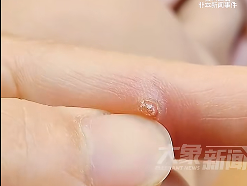 湖北女子感染HPV，回家过年的第一批“受害者”出现了…（组图） - 2
