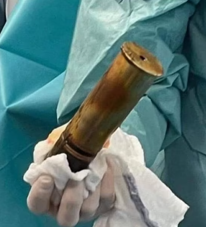 “菊花”卡炮弹!小哥半夜捂着屁股冲进急诊,医生急呼拆弹专家(组图) - 6