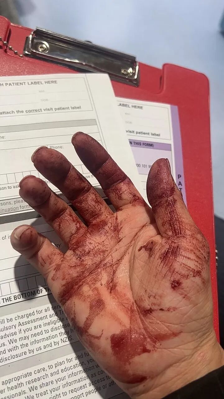 中国网红新西兰街头直播遭10人围殴，满脸鲜血，鼻梁骨折！“签证还有10天到期，想讨回公道”（组图） - 4