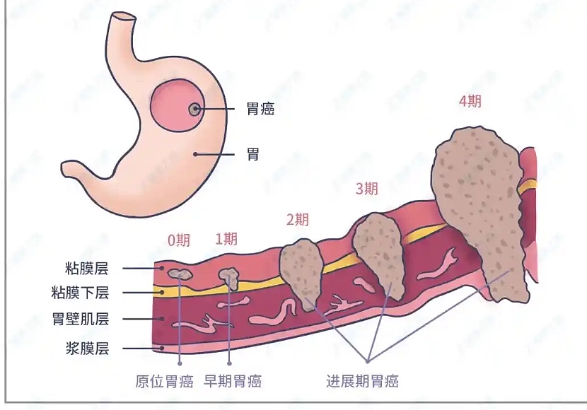 全球40%的胃癌，发生在中国（组图） - 2