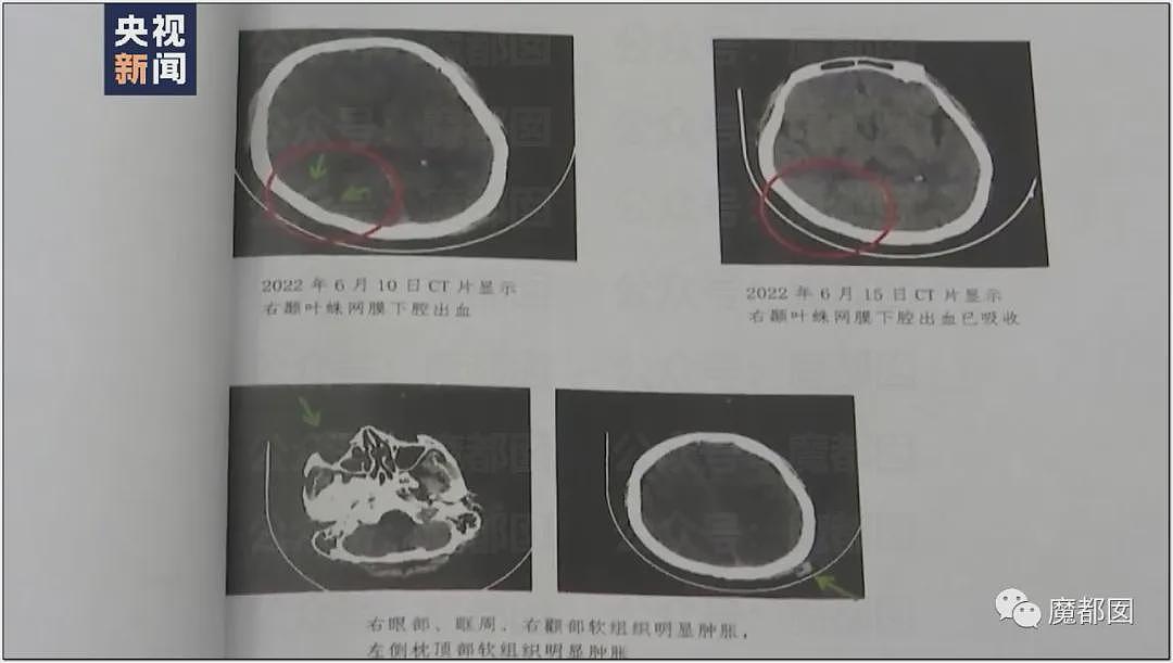 平顶山最新通报披露:先打3人再暴打15岁女孩;女孩被继父威胁,帮凶竟是妈妈(视频/组图) - 12