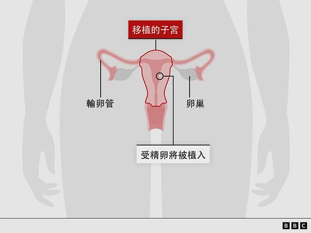 英国首名婴儿透过已故捐赠者子宫移植诞生(组图) - 3