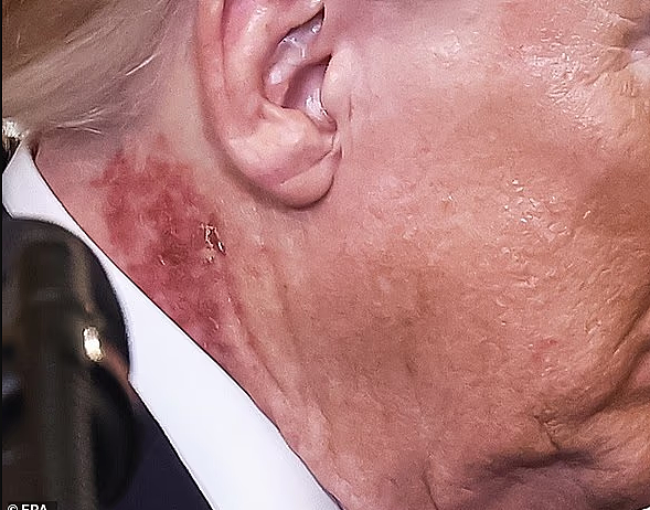 特朗普颈部突然出现大片红斑，白宫回应反而引发更多疑问（组图） - 2
