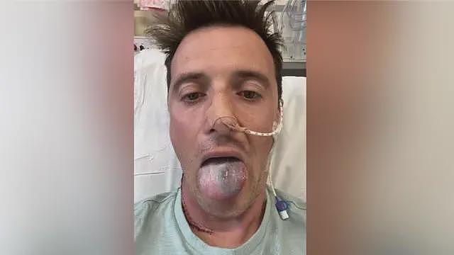 因癌症差点失去舌头的父亲，呼吁男性认识HPV（组图） - 2