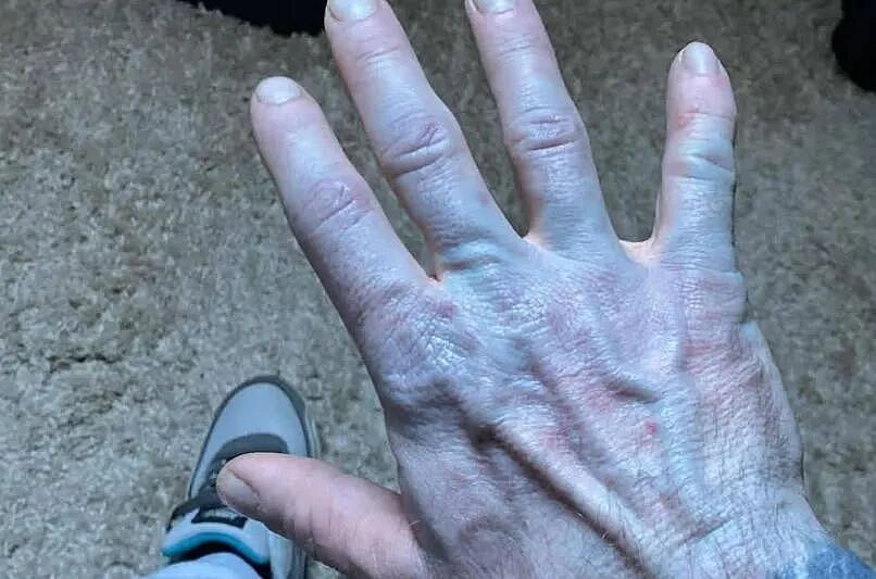 男子一觉醒来全身发蓝，被紧急送医院！结果医生拿酒精一擦，尴尬了…（组图） - 1