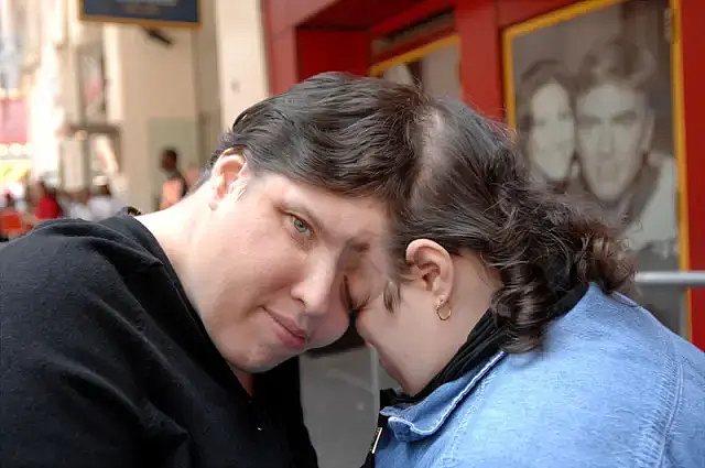 世界最老连体双胞胎姐妹变兄妹！姐姐公开变性，称瞒了妹妹46年？（组图） - 11