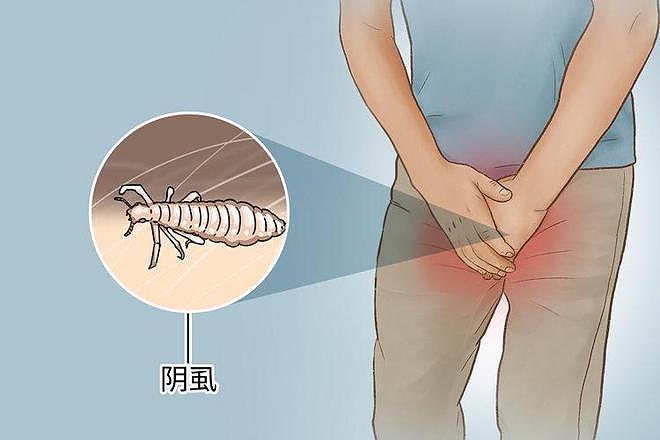 【涨知识】女子腹部痒，医生用镊子夹出16只阴虱！原来阴虱有3个传播途径（组图） - 2