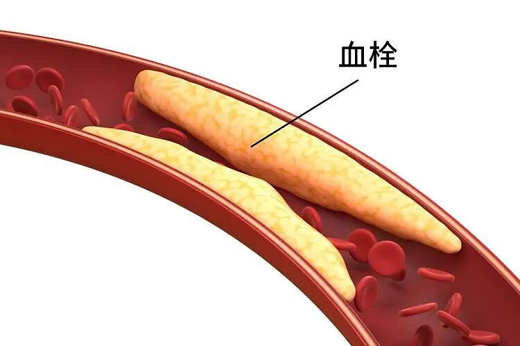【健康】“血栓大户”被揪出!再次提醒:劝你少吃3种食物,越吃血管越堵(组图) - 2