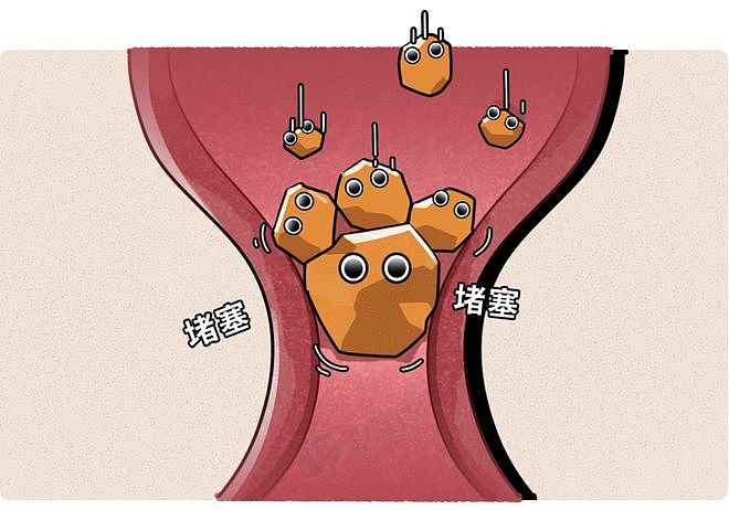 【健康】马上停止这5类运动，很可能加速血栓形成，等血管“堵死”就迟了（组图） - 2