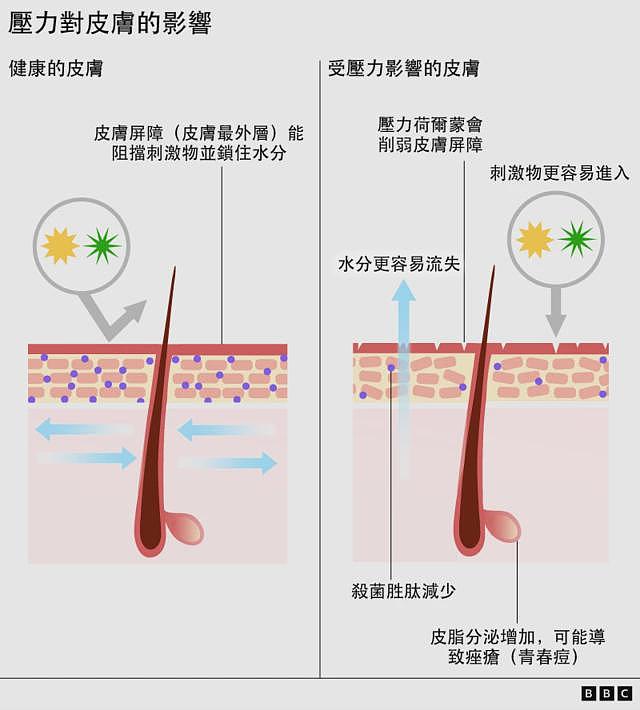 压力对皮肤有什么影响——以及你能怎么做（组图） - 3