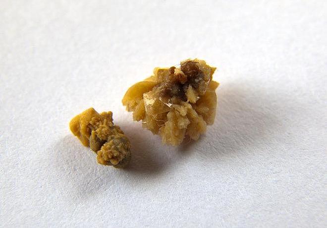 世界上最疼的病是什么病？疼痛排名前6的病，经历过的都是超人（组图） - 6