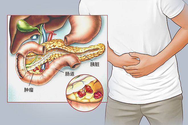 【健康】一天三四次,57岁男子癌症晚期,妻子泣不成声:还以为是正常的(组图) - 5