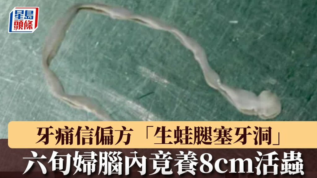 牙痛信偏方生蛙腿塞牙洞!六旬妇脑内竟养8cm活虫(组图) - 1