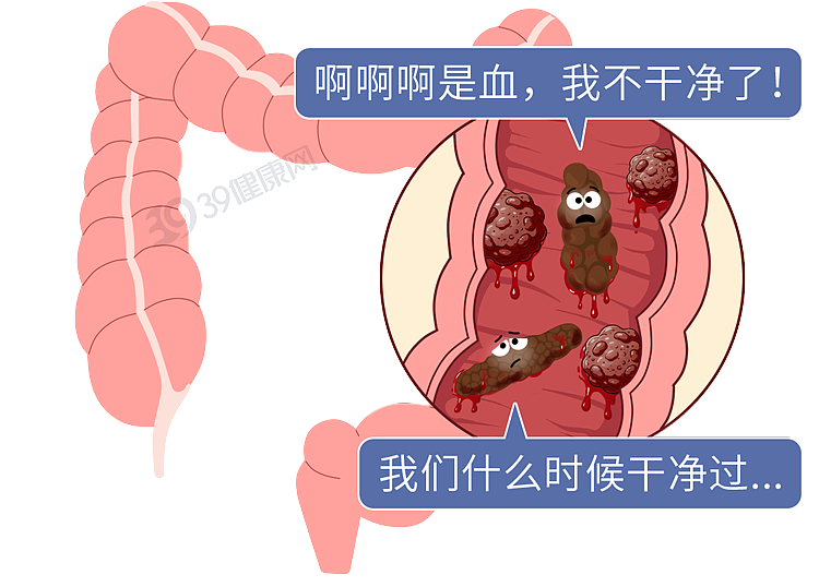 体内有癌,大便先知?若粪便出现3种异常,当心肠癌预警(组图) - 10