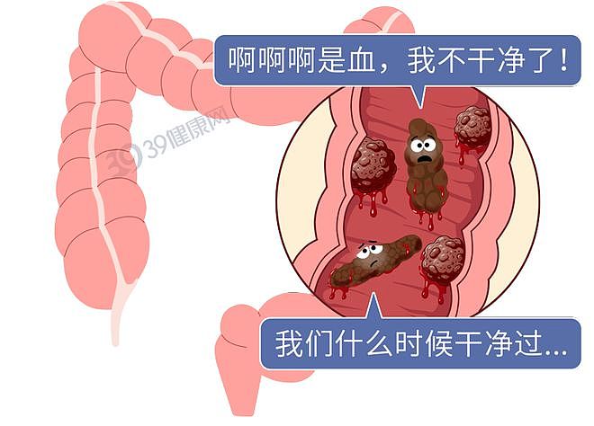 【健康】体内有癌，大便先知？提醒：若粪便出现3种异常，当心肠癌预警（组图） - 10