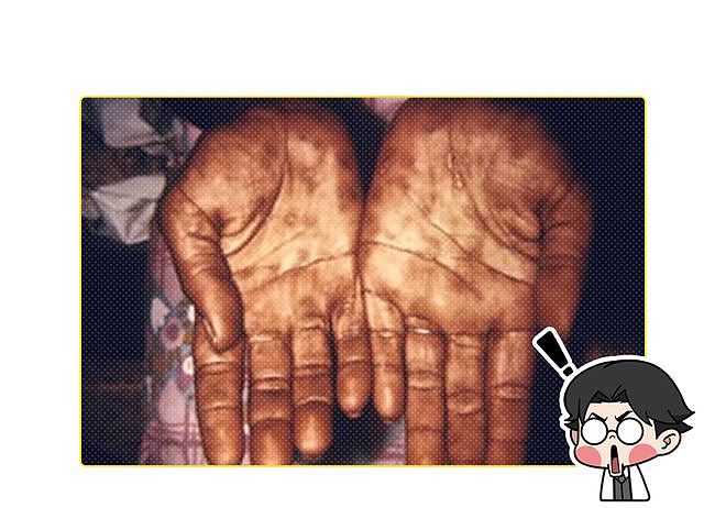 52岁男子总怀疑妻子偷吃,一查竟是晚期梅毒!身体3种异常要当心(组图) - 11