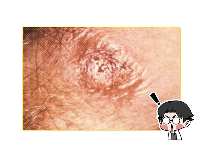 52岁男子总怀疑妻子偷吃,一查竟是晚期梅毒!身体3种异常要当心(组图) - 10