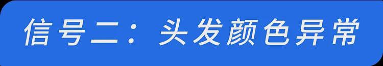 【健康】体内有疾时,头发会有4种迹象,若1个不占,恭喜你(组图) - 8