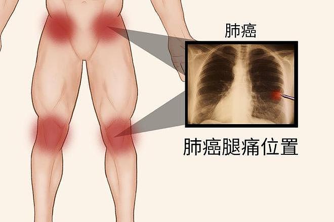 【健康】肺癌来临，腿部先知？提醒：双腿出现4个异常，建议尽早检查CT（组图） - 7