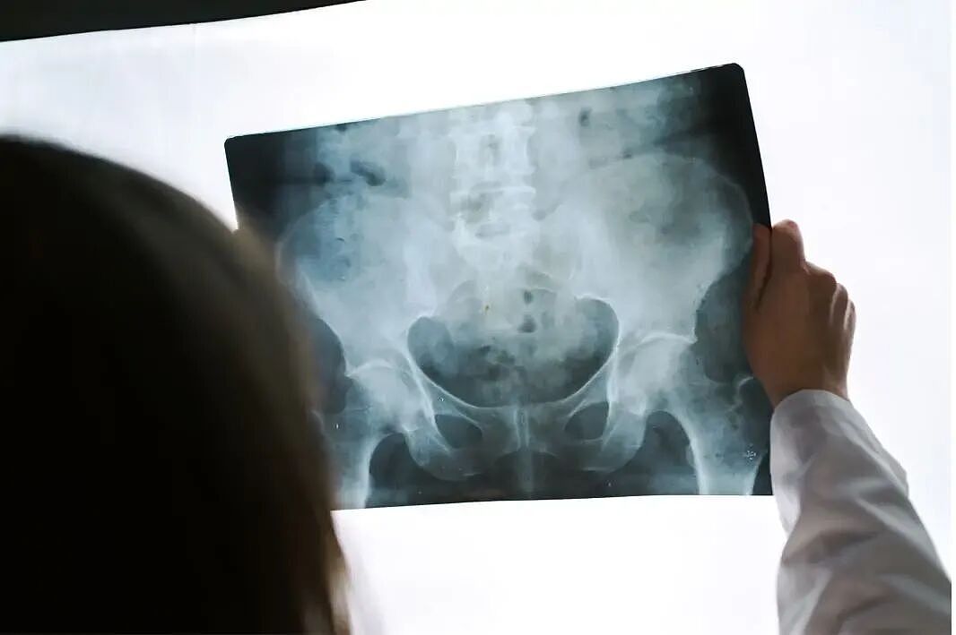 争吵升级酿命案！奥克兰女子被控谋杀同居男友！新西兰手术后腿长差3厘米！确认医生术中测量失误！（组图） - 6