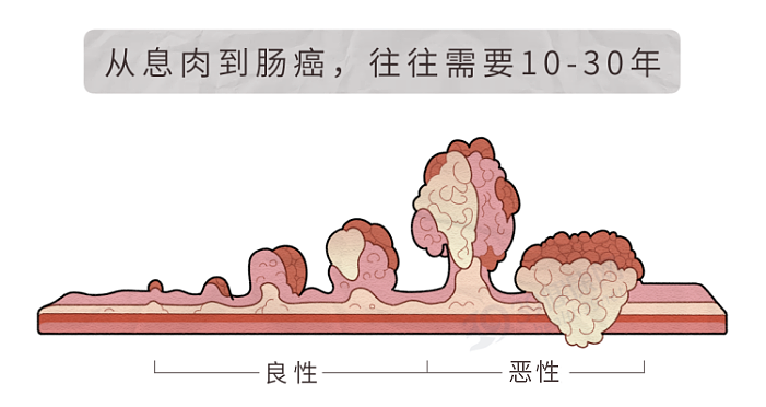 为何肠癌一发现就是晚期？提醒：身体有5个异常，当心癌症信号（组图） - 10