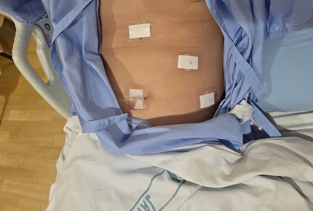 奥克兰急诊止痛无效!检查被拒!华人男子被反复判胃炎!最终确诊胆囊严重化脓摘除!新西兰40岁母亲连续被误诊数周!最终确诊卵巢癌四期! - 3