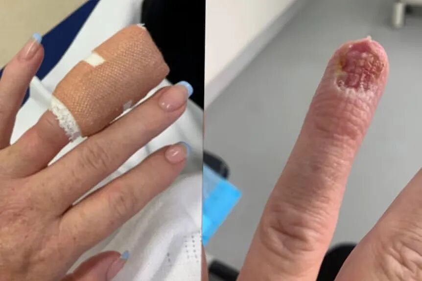 就因为进了一趟美甲店,澳女染上败血症!脚差点没了(组图) - 4